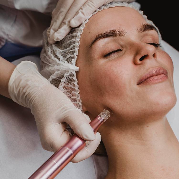 Dermapen Treatment